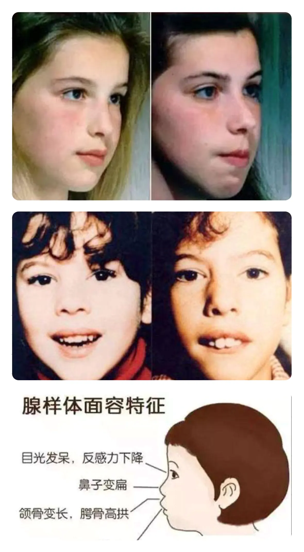 腺样体肥大造成长期张口呼吸,气流冲击硬腭,导致上颌骨变长,下颌后缩