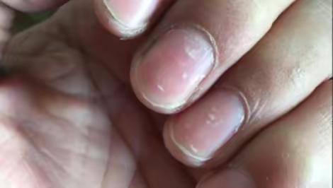 看指甲上的“记号”，了解身体健康状态。