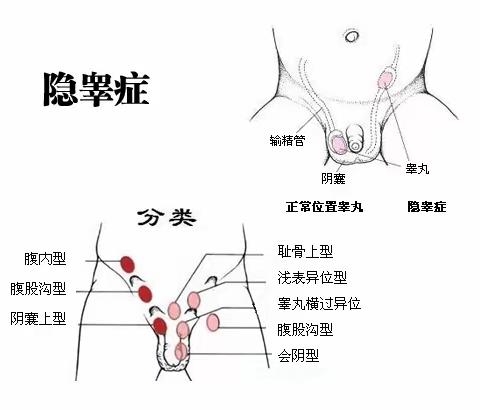 快看看你家的小孩有隐睾吗？