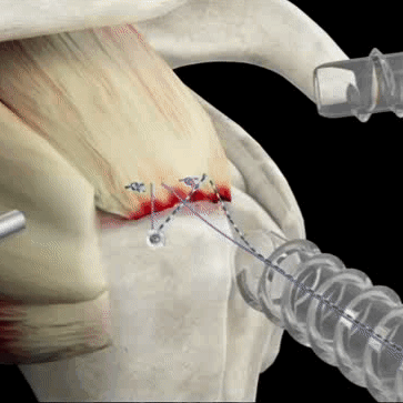 【科普】 关节镜下肩袖修补术