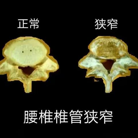 一分钟了解各类引起椎管狭窄的病因