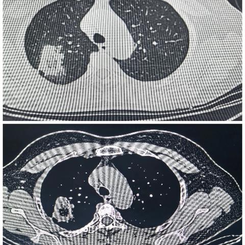 射频残留危害大，外科手术解烦忧——射频消融后外科手术治疗