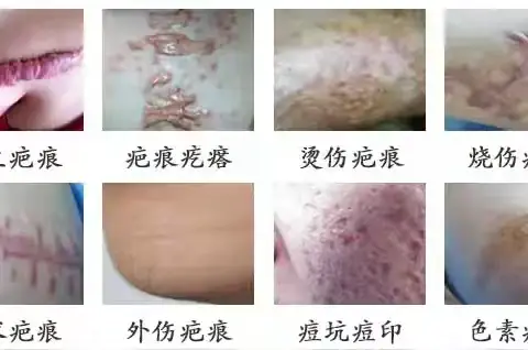 告别疤痕困扰，皮肤科为您重塑肌肤自信