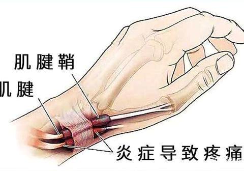 作业治疗：腱鞘炎患者康复新选择