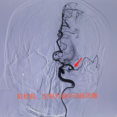 急诊开通，挽救生命——阳煤集团总医院完成一例卒中绿道急诊经皮颅内动脉取栓