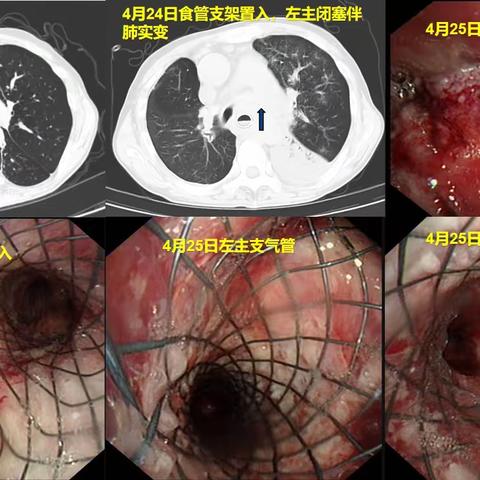 阳煤集团总医院完成阳泉市首例气管镜下“Y型”支气管支架置入