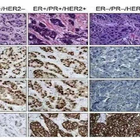 【周医 病理科】免疫组织化学检查在病理诊断中的作用