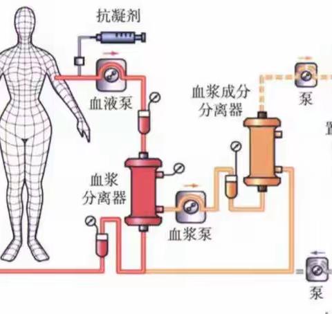 我院用双重血浆滤过新技术治疗高脂血症取得显著疗效