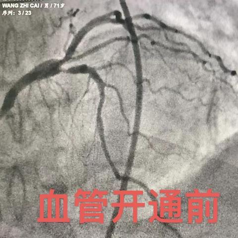 生命第一！我院胸痛中心成功救治一例急性心梗患者