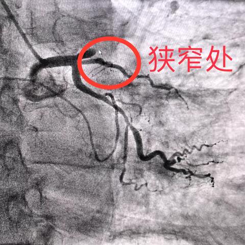 “救心接力赛”—梓潼县人民医院胸痛中心联动，全力抢救一名急性心肌梗死患者！