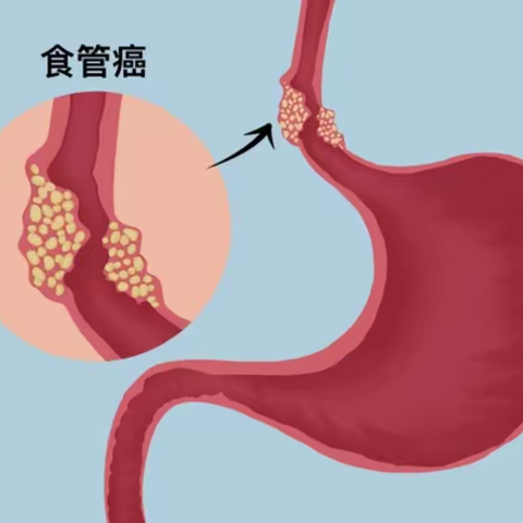 谈癌色变之食管癌