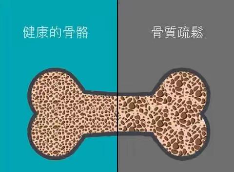 骨质疏松知多少！