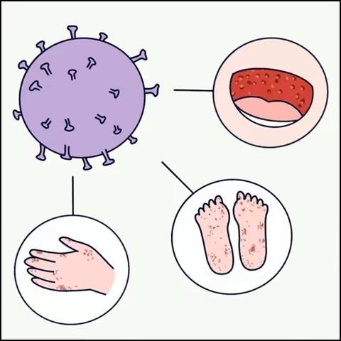 “手足口”病不用慌，短波紫外线治疗仪来帮忙