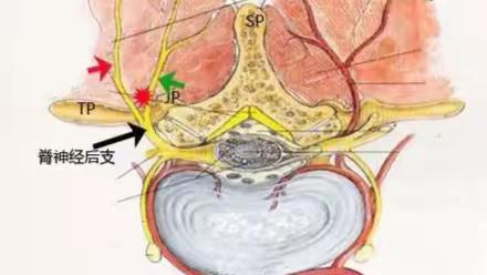 超声引导下脊神经后支的阻滞：下腰痛的一种解决方案