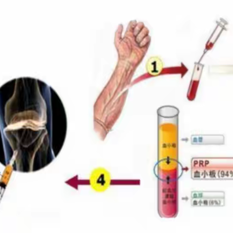 滇东北区域中心医院疼痛科开展富血小板血浆（PRP）治疗术