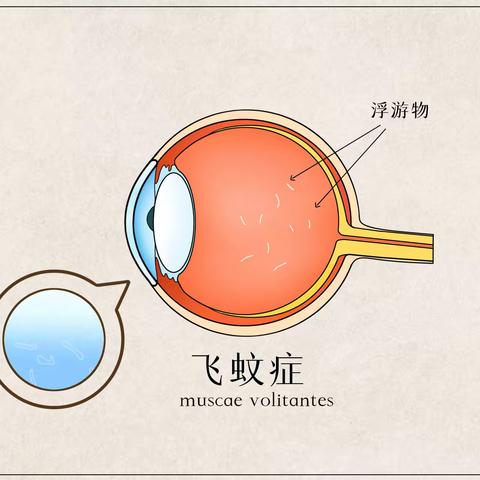 眼前常常有黑影？有可能是飞蚊症