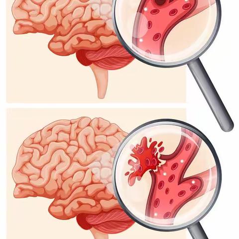 世界预防中风日 | 发病快易致残，中风该如何预防？