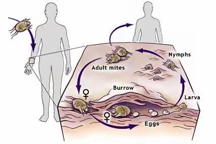 疥疮反复发作？原因你们搞清楚了吗？