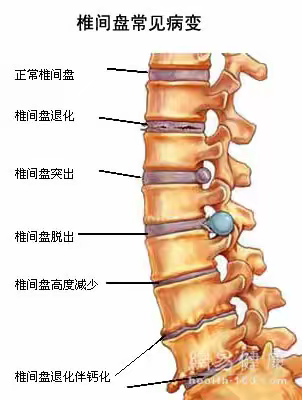 为什么你的腰会痛？