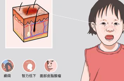 散结三联液治疗结节性硬化的区别