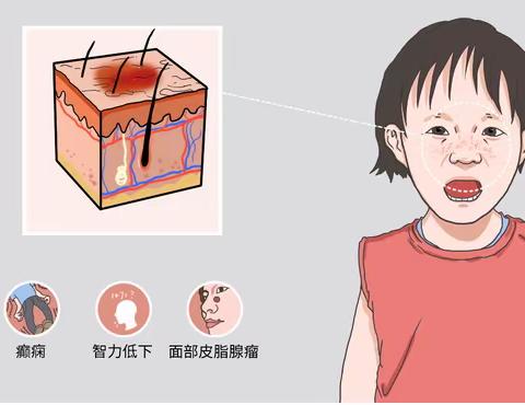 结节性硬化最新治疗康复案例