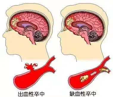 脑卒中康复训练之核心稳定性训练