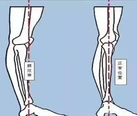 康复训练丨膝过伸的多种康复思路…