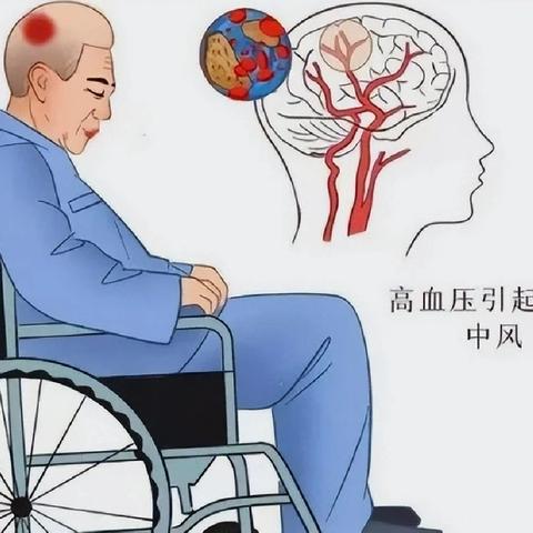 【健康知识普及行动】老年脑卒中