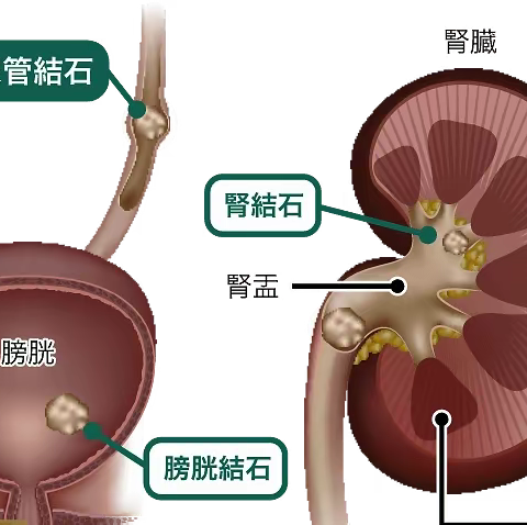 【医学科普】泌尿系结石，早知道少痛苦（副本）