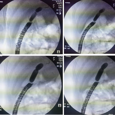 经内镜治疗胰十二指肠切除术后胆管结石及吻合口狭窄