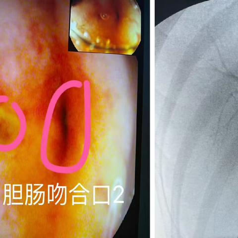 经内镜治疗胰十二指肠切除术后胆管结石及吻合口狭窄（副本）