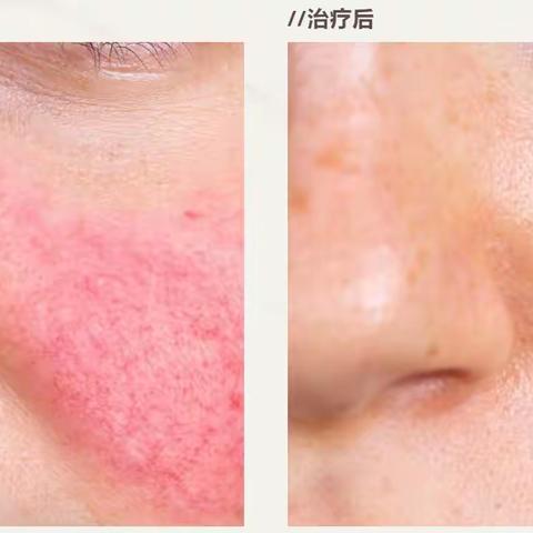 激光嫩肤是什么？效果如何? 有什么利与弊？