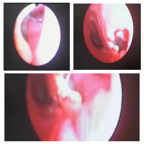 气管食管“串通一气”，纤支镜下“原形毕露”