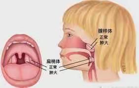 放假了，来做扁桃体、腺样体的宝爸宝妈注意了！