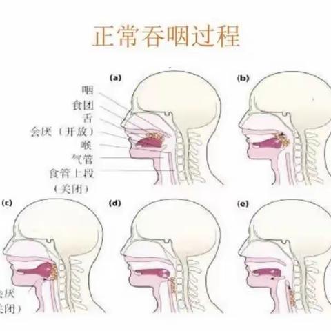 吞咽障碍知多少