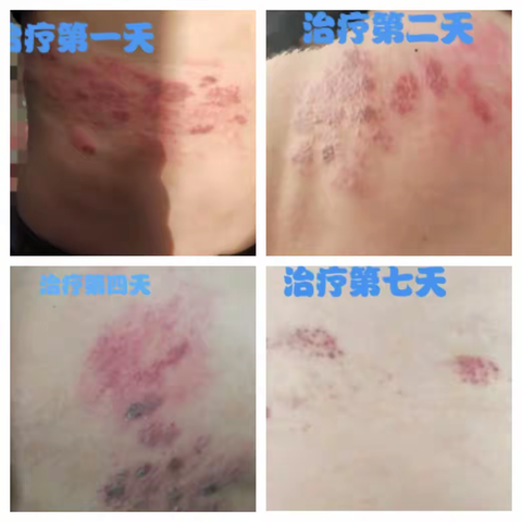 中医特色疗法治疗带状疱疹效果显著