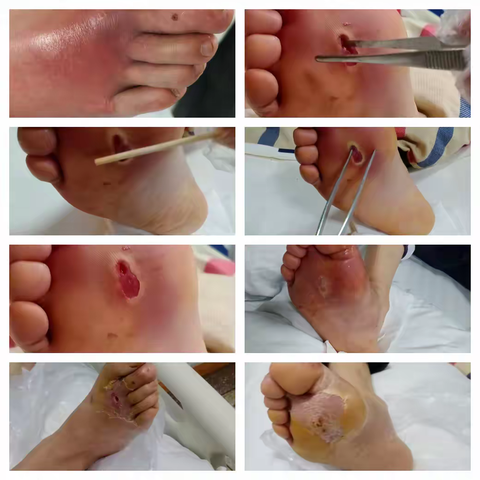 中医药治疗糖尿病足部感染一例
