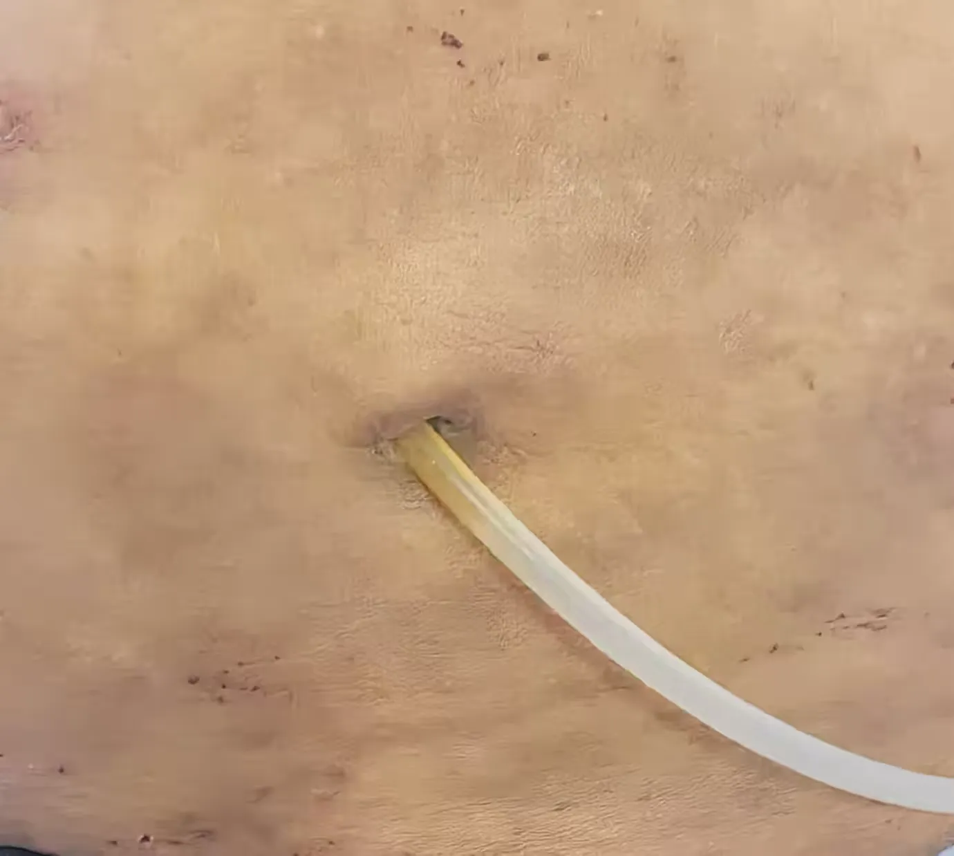 腹透专职护士胡小燕在给患者进行隧道口处换药