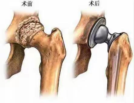 【骨科案例】骨科髋膝关节置换，让您的关节重新焕发活力