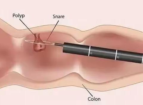 如何预防肠息肉？