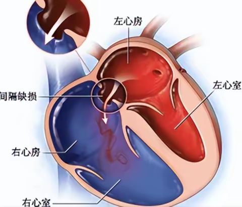 房间隔缺损及房间隔介入封堵术