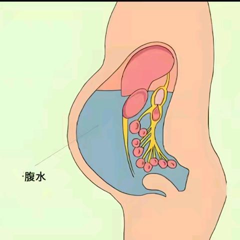 运用中药，舒舒服服消腹水！