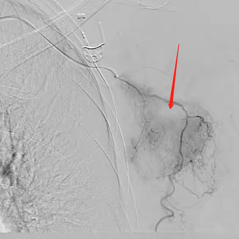 食管癌腋窝淋巴结转移瘤动脉栓塞术：新希望之光