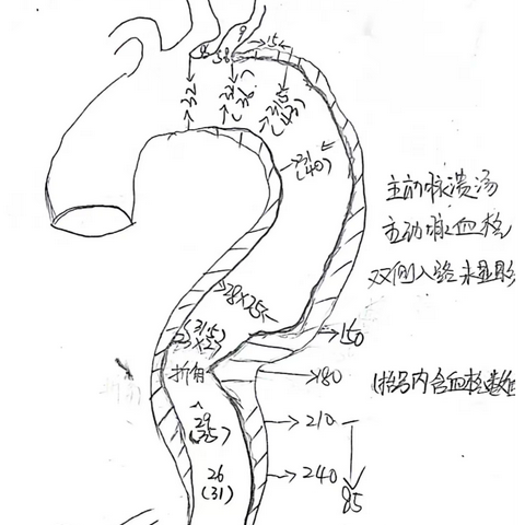 我院首例烟囱技术V2区主动脉夹层腔内隔绝术+左锁骨下动脉重建术成功完成