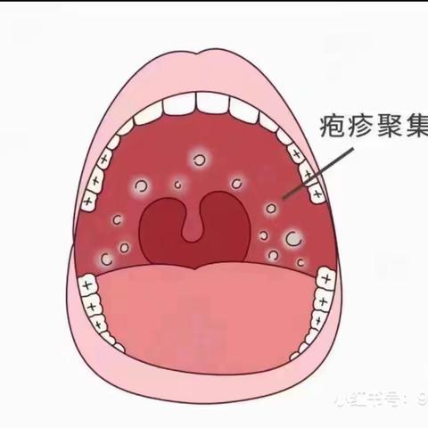 【温馨提示】思南县伯乐幼儿园 秋季常见的幼儿传染病预防指南