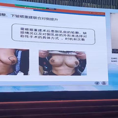 乳腺重建术后调整（吴炯）