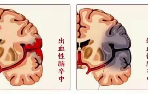 四进四送四提升——可怕的脑出血如何识别、急救和预防？