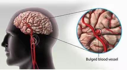 脑动脉瘤的爱恨情仇