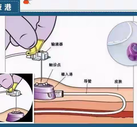 输液港、PICC导管维护和健康宣教