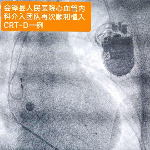 CRT-D治疗一例